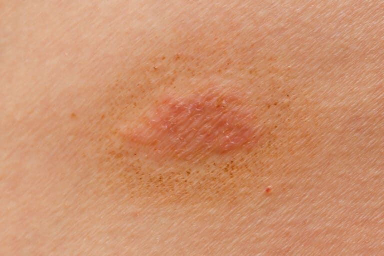 7 Tips To Help You Avoid Ringworm In BJJ And Wrestling
