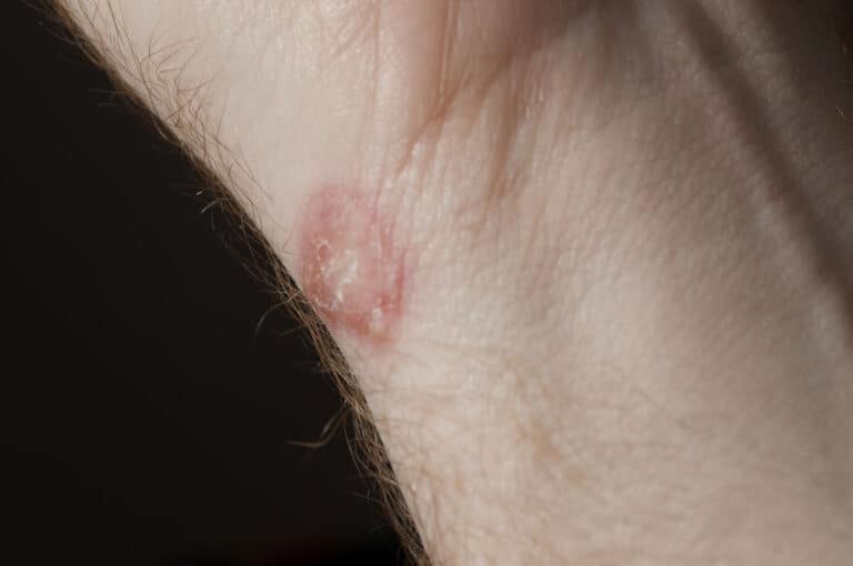 Why Do Wrestlers Get Ringworm and Staph Infections? Grappling School